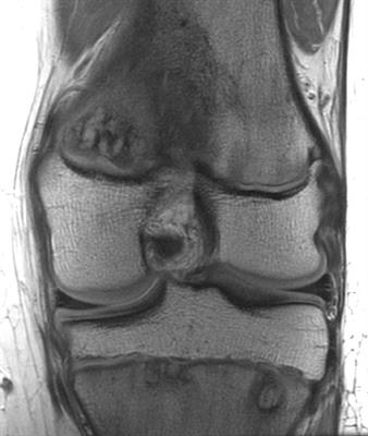 When Local Bone Pain Is Just the Tip of the Iceberg—A Case Report of Three Patients With Chronic Multifocal Recurrent Osteomyelitis and Some Red Flags to Help Make the Diagnosis